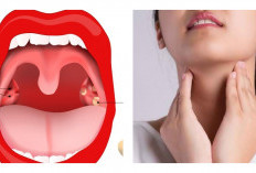 Kenali Penyebab Batu Amandel dan Cara Mengatasinya