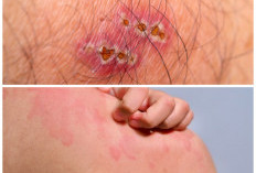 Kenali 5 Jenis Infeksi Kulit karena Bakteri Lengkap dengan Cara Penanganannya